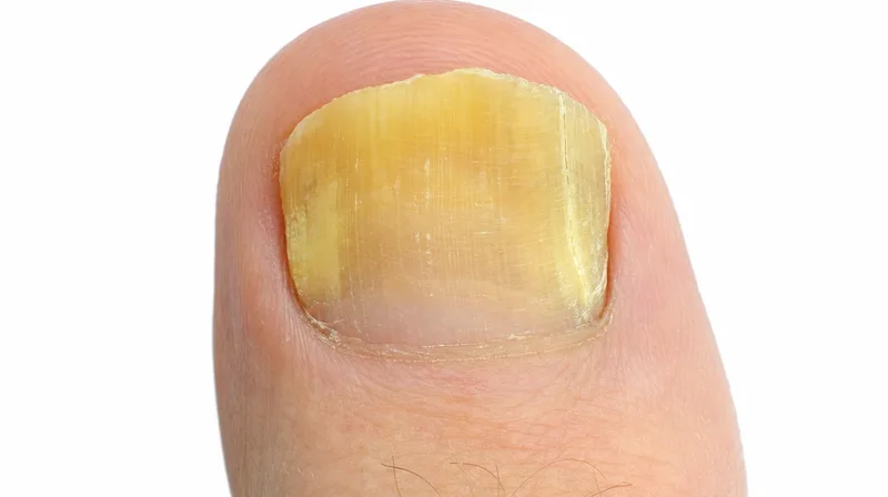 Gelb verfärbter Fußnagel am großen Zeh als Anzeichen für Nagelpilz oder andere Ursachen